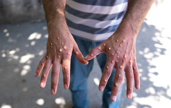 Paciente con mpox o viruela símica.