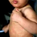 Alerta epidemiológica en varios países de la región por casos de sarampión en EEUU y México 