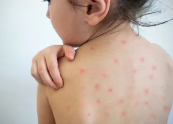 Sarampión en Centroamérica: Guatemala, Honduras y El Salvador activan alertas sanitarias