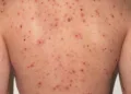 Sarampión en Centroamérica: Guatemala, Honduras y El Salvador activan alertas sanitarias