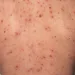 Sarampión en Centroamérica: Guatemala, Honduras y El Salvador activan alertas sanitarias