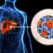 EE.UU. alerta por brote de hepatitis A en Costa Rica