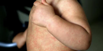 Guatemala concentra más de 34,000 contagios de sarampión
